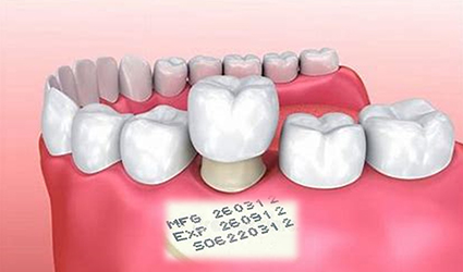 Does Your Dental Crown Comes with An Expiry Date?