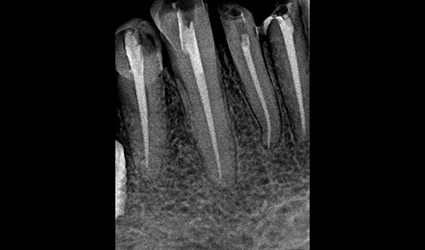 Is The Root Canal Treatment Painful: Let’s Take The Pain Out Of It