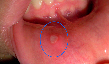 The Painful Truth: Understanding Oral Ulcers